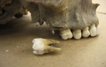 A molar removed from skeletal remains as an example of calcified tissue.